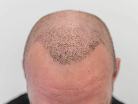 What Is the Process of a Hair Transplant?