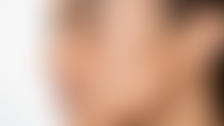 What Are Melasma Treatment Options?