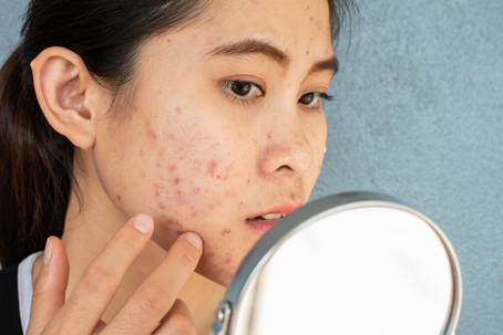 What Are the Most Effective Acne Treatment Methods?