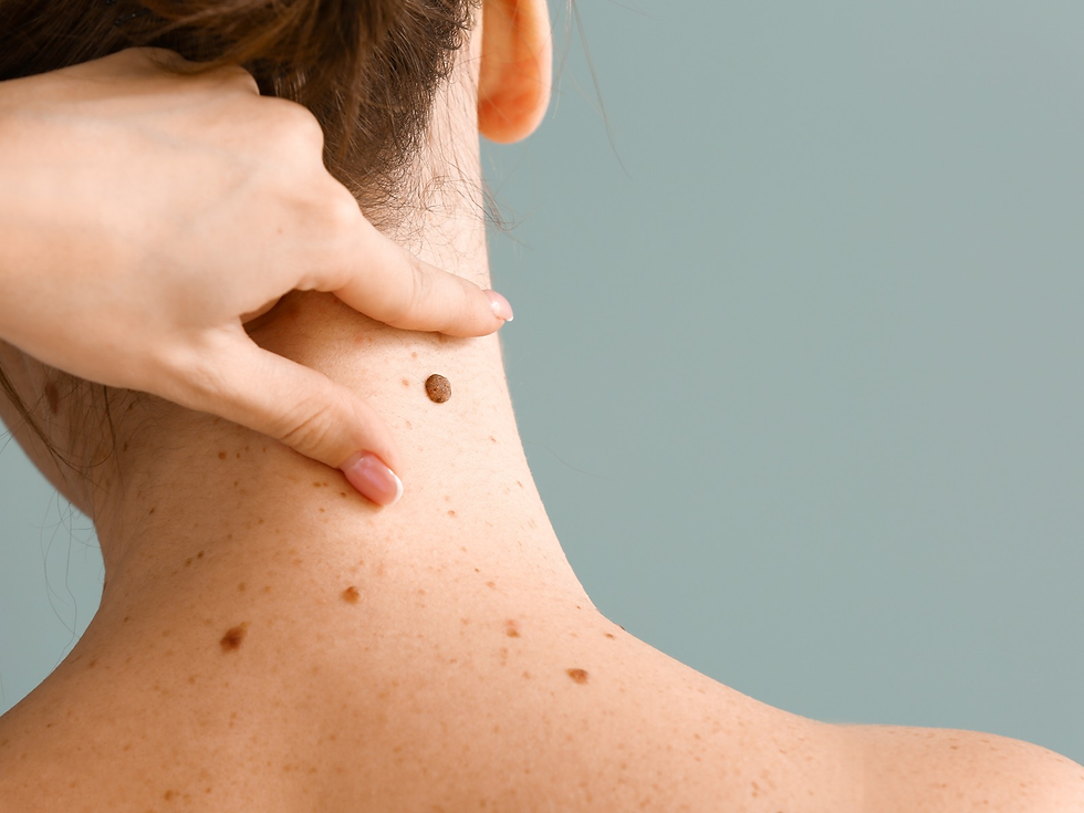 What Moles Removal Reveals About Cells?