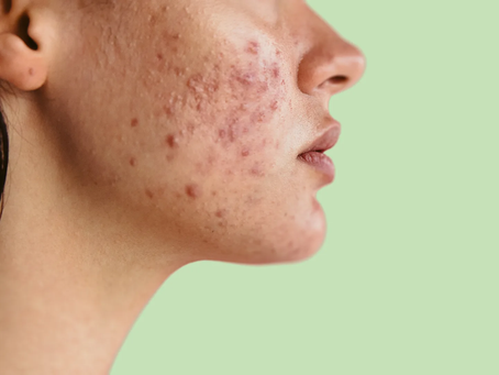 Is Acne Treatment Effective for All Skin Types?