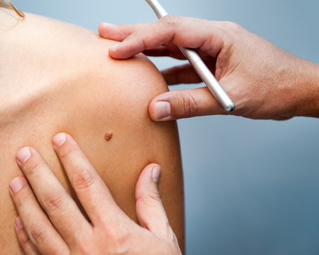 What Causes Warts and How to Remove Them