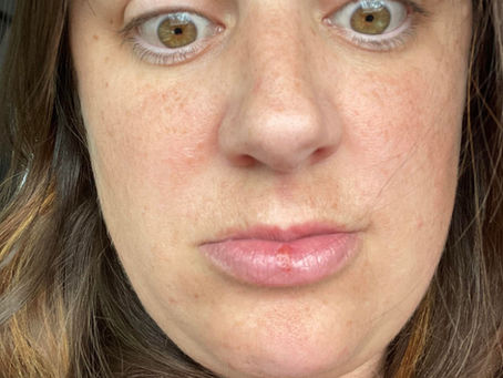 Call an ambulance! My lips are chapped!