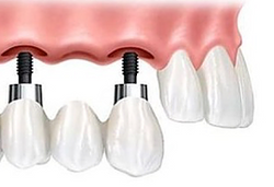 implantes-dentales-1