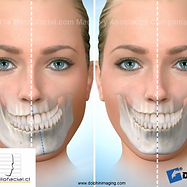 Asimetría facial