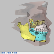 clase III cirugia.png