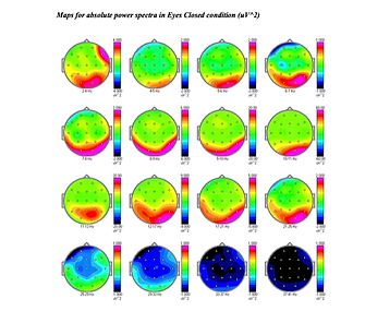 Example of qEEG Brain Mapping Complete Report copy (dragged)-1.heic