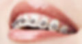understanding-metal-braces
