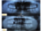 Single Implant Sinus Lift Case