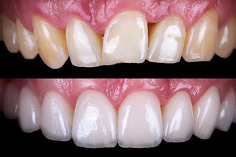 dental ceramic Veneers