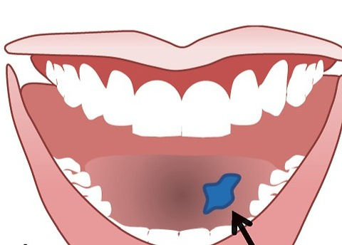 animation representing intra oral dye screening