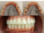 All-on-Six full Mouth Implant Bridge