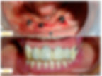 Fixed Denture