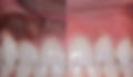 Gum-Depigmentation