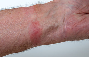 skin irritation, contact dermatitis, rash from smart watch or fitness band