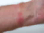 Red, inflamed, irritated, eczematous skin patch on a person's wrist where a smartwatch, watch band, watch strap was worn. The background is plain white, emphasizing the rash's color and texture.