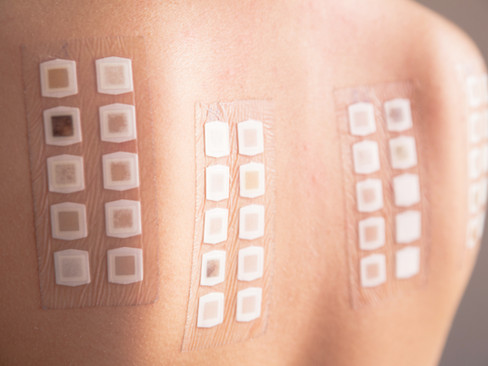 Patch testing