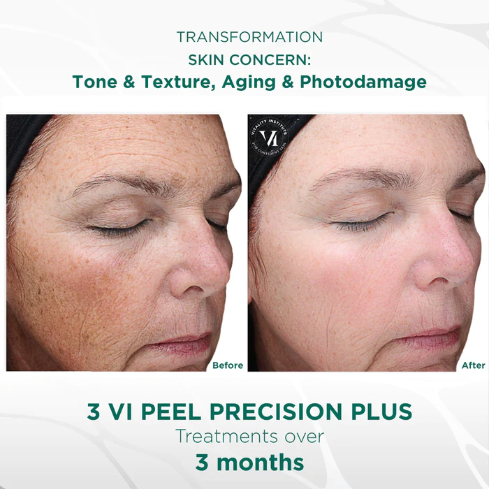 VIPeel_PrecisionPlus_BeforeandAfter_700x.webp