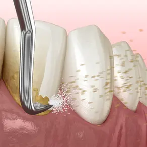 Deep Cleaning vs Regular Dental Cleaning in Vancouver: Which Treatment Is Right for You?