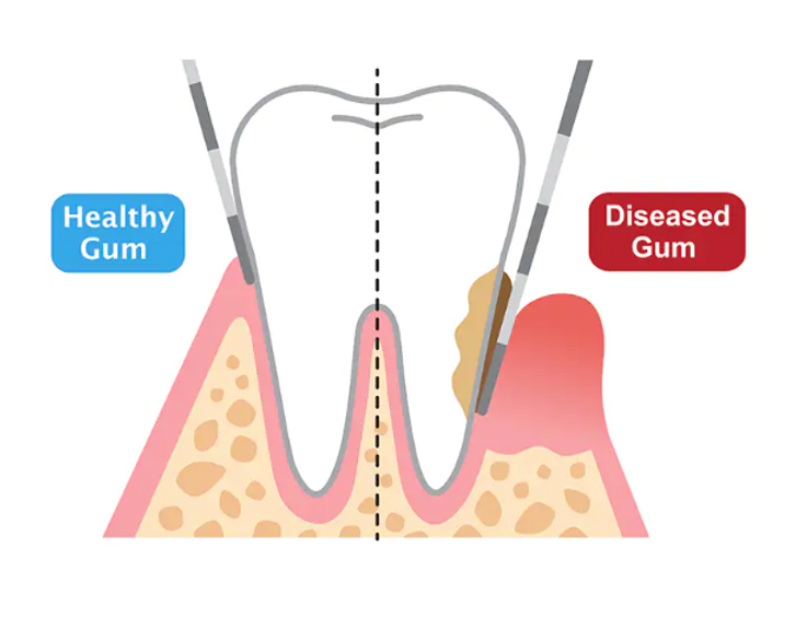 Periodontal Probing at Luxe Dental Hygiene