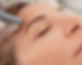Sonoma Mobile Microneedling