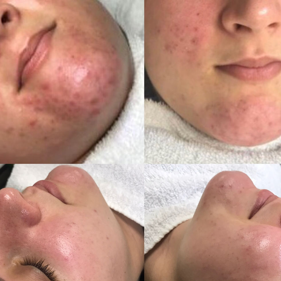 Facial Skin Treatment Results