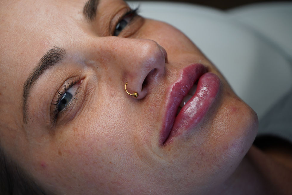 Directly after lip filler service
