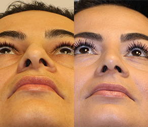 Rhinoplasty Before & After F07