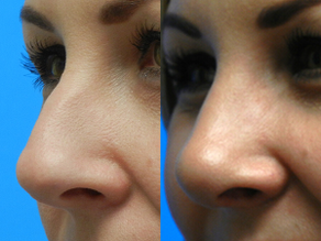Rhinoplasty Before & After F10 