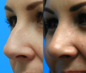 Rhinoplasty Before & After F10 