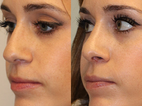 Rhinoplasty Before & After F09