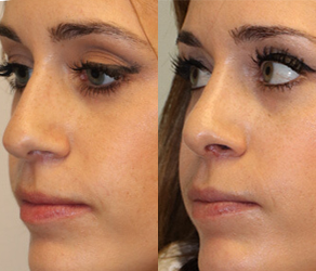 Rhinoplasty Before & After F09