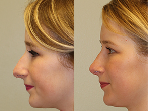 Rhinoplasty Before & After F06