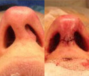 Rhinoplasty Before & After F03