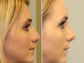 Rhinoplasty Before & After  F08