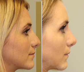 Rhinoplasty Before & After  F08