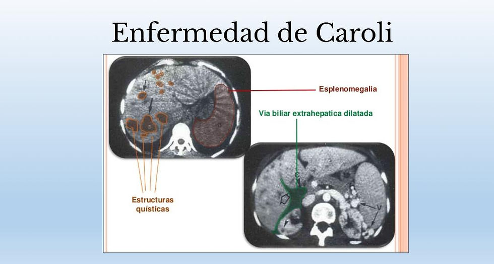 La enfermedad de Caroli es un trastorno congénito poco frecuente que se caracteriza por la presencia
