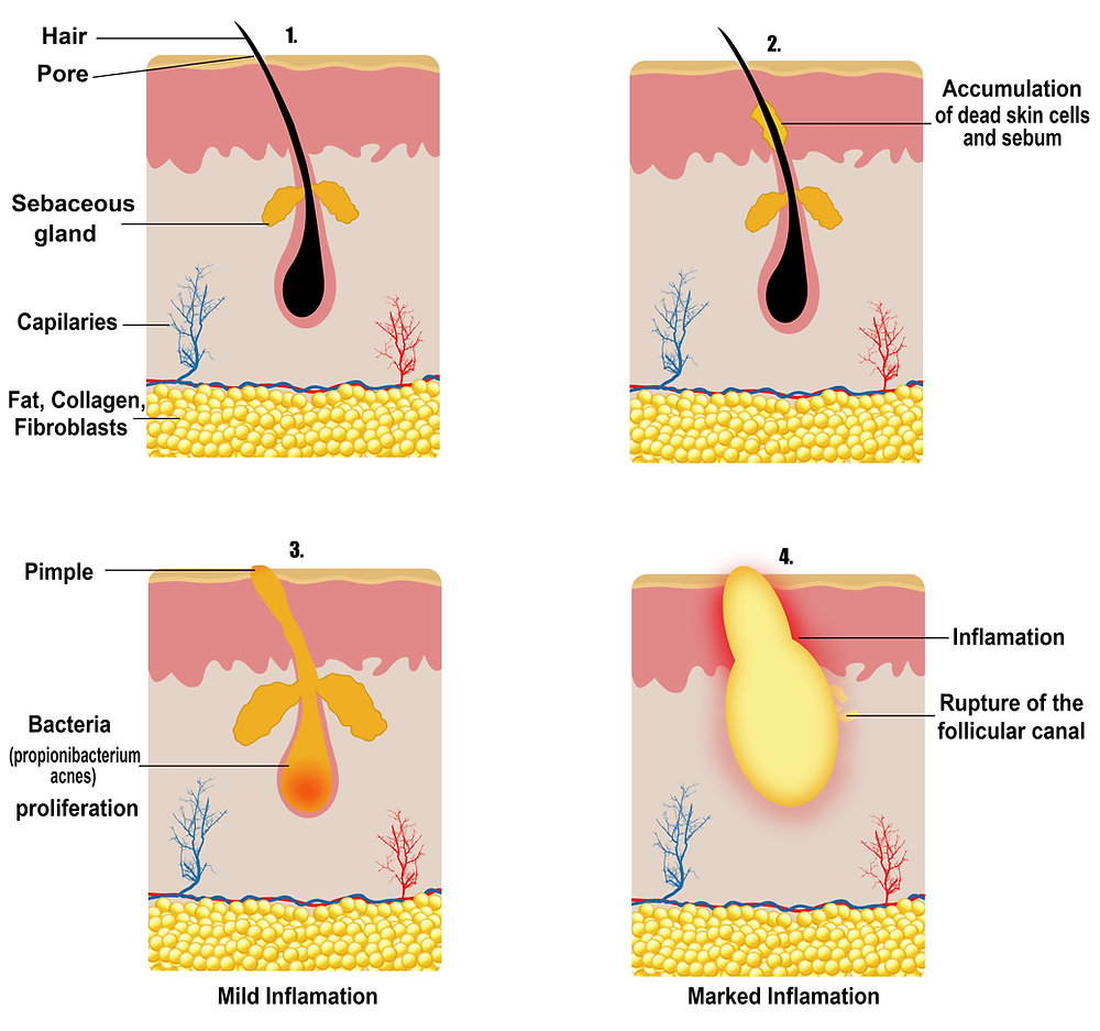 How Acne Develops Acne: What, Why, How? | Blog | Dr Hala