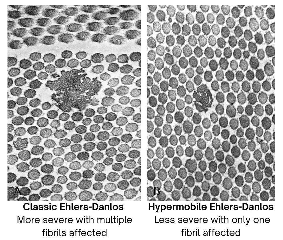An image comparing close up images of classic Ehlers-Danlos tissues on the left compared to the more mild hypermobile Ehlers-Danlos tissues on the right. The image on the left shows a smaller cauliflower shaped clump, whereas the image on the right shows a smaller and less misshapen clump.