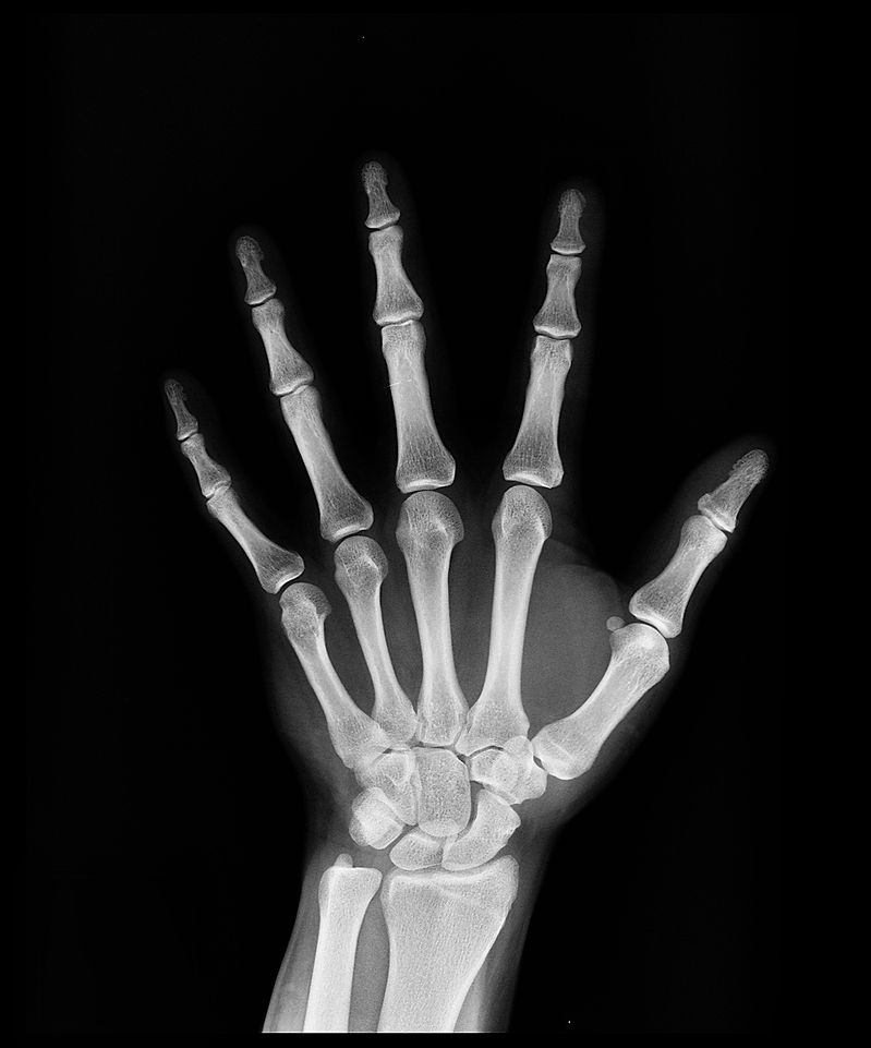 Xray of Hand.png
