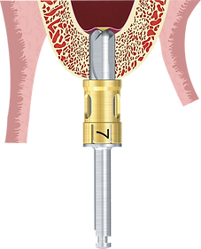 interner Sinus-Lift, Sinus Lift