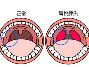 扁桃炎 慢性扁桃炎 繰り返す喉の痛み