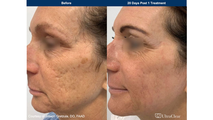 UltraClear laser-coring results