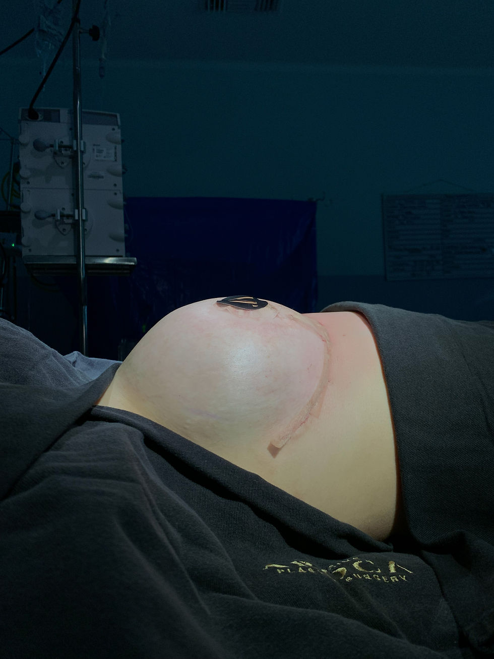 Reduction Mastopexy