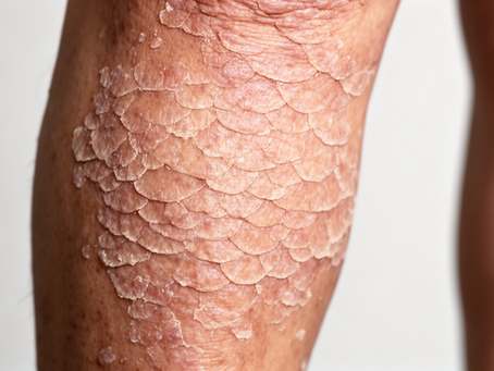Pityriasis Versicolor skin condition - Apollo Homeopathy Clinic Brampton
