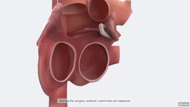 The Artificial Heart That Will Save Countless Lives