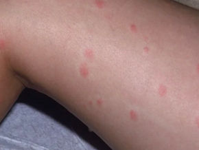 Swimmer's Itch at Greenwich Point beach