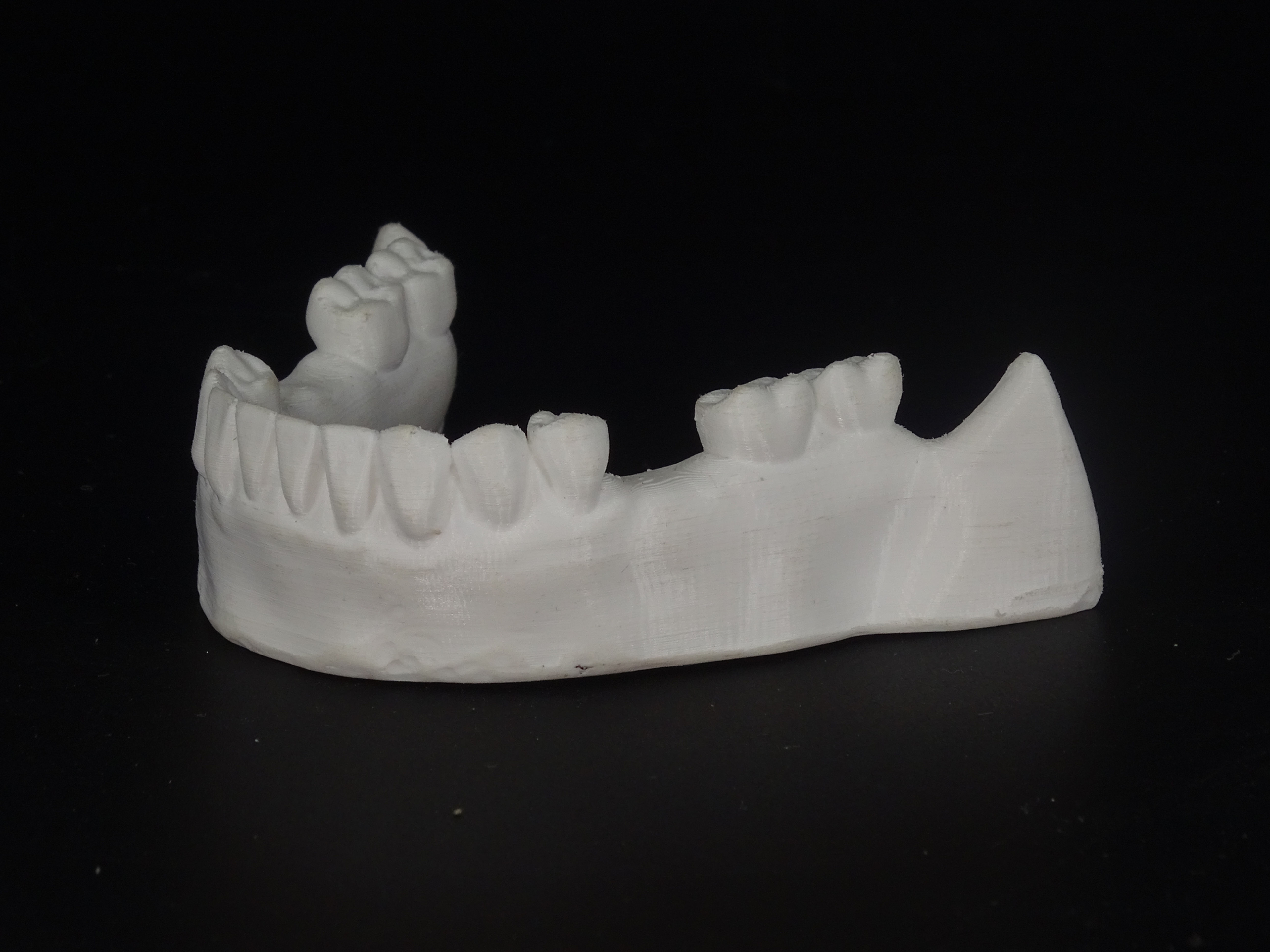 Partially Edentulous Mandible