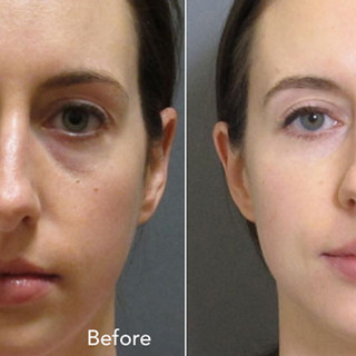 Dermal+Fillers+Before+&+After.003.jpeg
