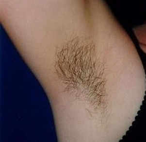 sugaring before and after